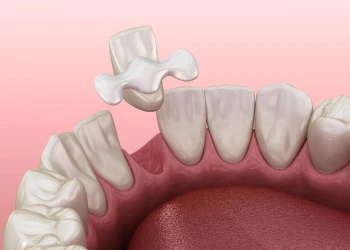 Maryland Köprü Nedir? Avantajları ve Dezavantajları
