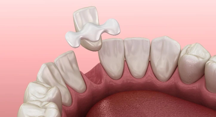 What is the Maryland Bridge? Advantages and Disadvantages