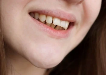 What is Overbite? What are its Causes?