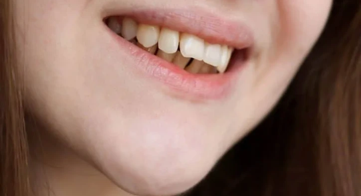 What is Overbite? What are its Causes?