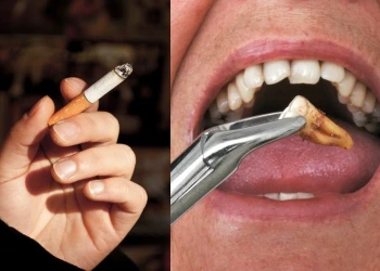 Diş Çekiminden Sonra Sigara İçilir mi?