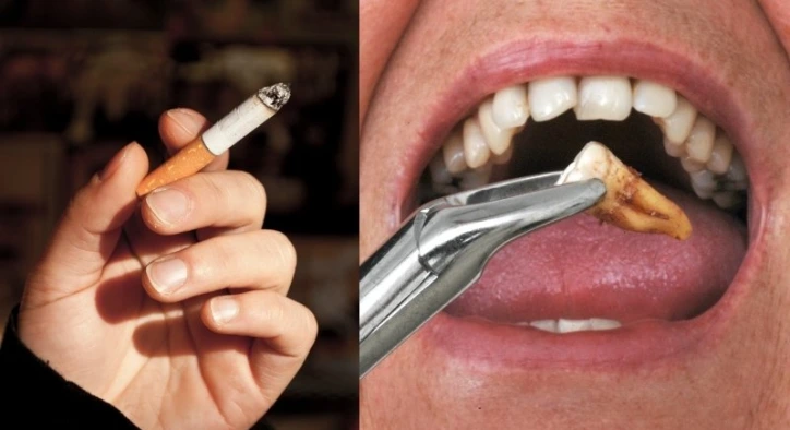 Diş Çekiminden Sonra Sigara İçilir mi?