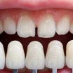 Veneers ohne Zahnabschleifen: Wie funktioniert das?