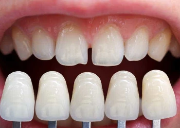Dişleri Törpülemeden Veneer Kaplama Nasıl Yapılır?