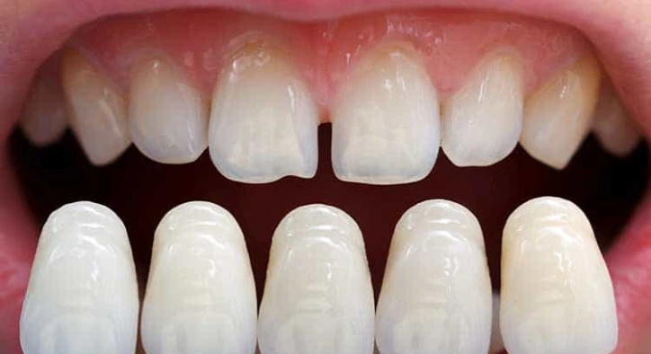 Veneers ohne Zahnabschleifen: Wie funktioniert das?