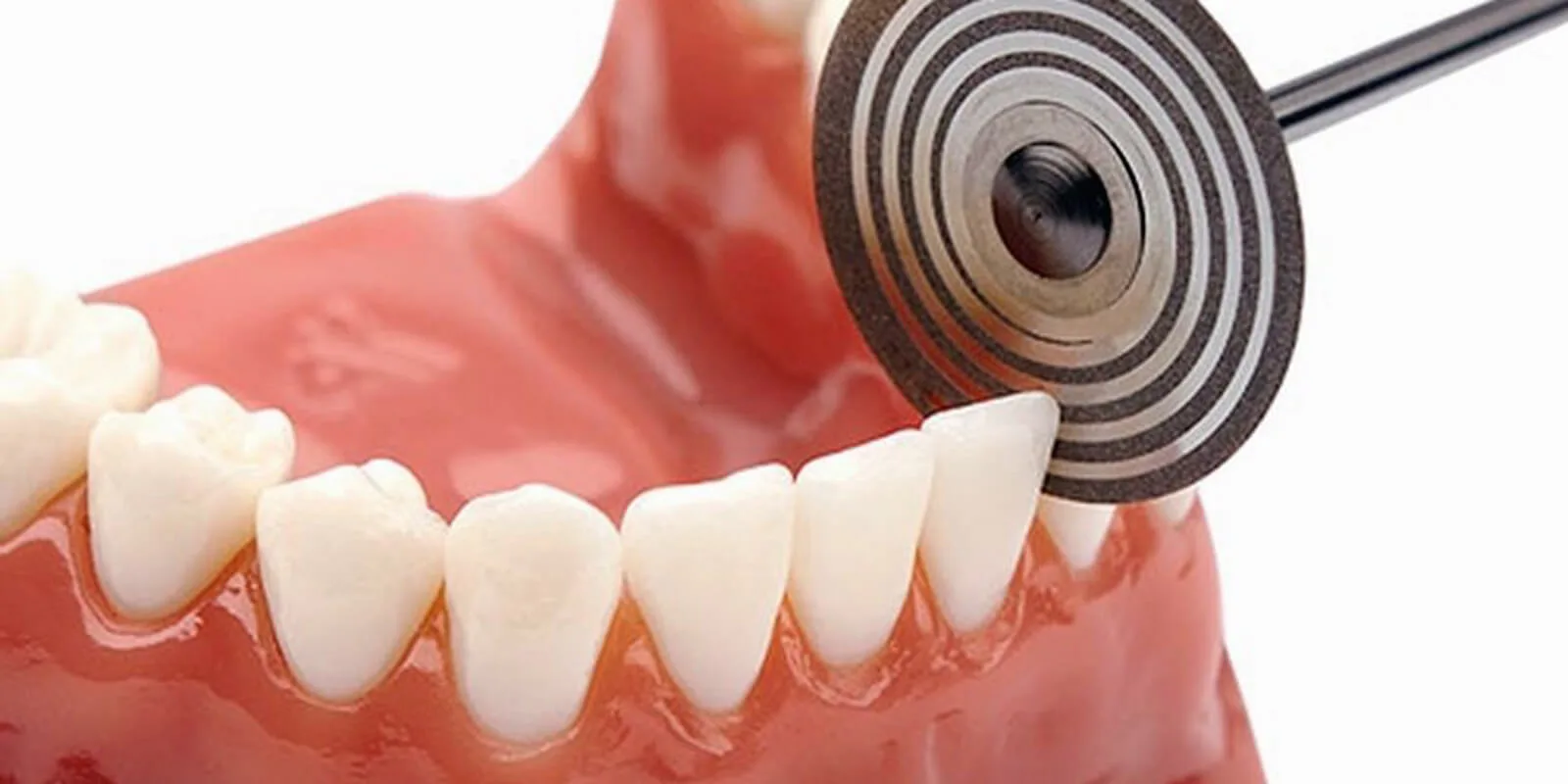 Veneers ohne Schleifen - Minimal-Prep Veneer Verfahren bei Avrupa Sağlık Diş Antalya