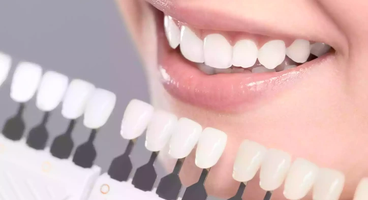 Can Veneers Be Whitened? What UK Patients Should Know