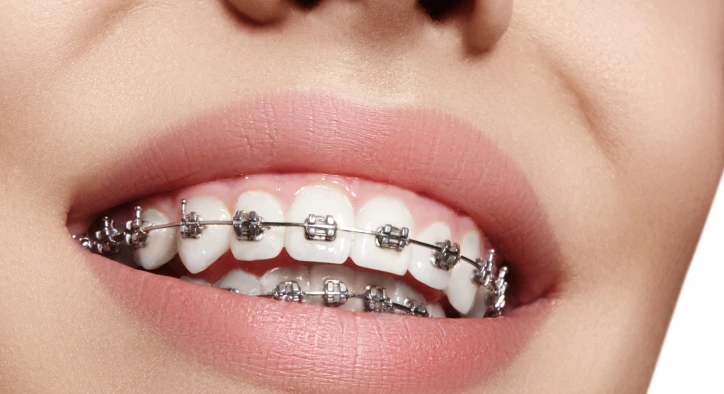 Ortodonti Nedir? Türleri, Faydaları ve Tedavi Seçenekleri