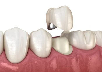 CEREC Kaplama: Teknoloji Hakkında Her Şey
