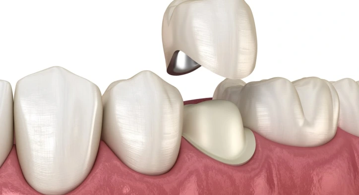 CEREC Kaplama: Teknoloji Hakkında Her Şey