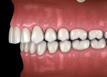 Derin Kapanış Nedir ve Nasıl Tedavi Edilir?