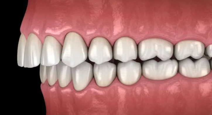 Derin Kapanış Nedir ve Nasıl Tedavi Edilir?