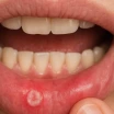 How to Get Rid of Canker Sores? Solutions for Mouth Sores