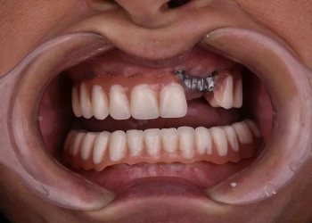 Ist ein Implantat an einem Tag möglich?