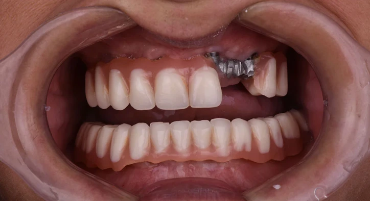 Ist ein Implantat an einem Tag möglich?