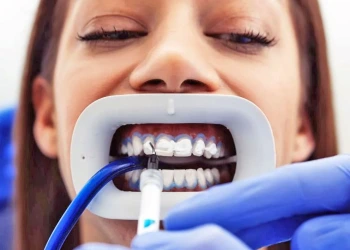 What Is Teeth Whitening, How Is It Done?