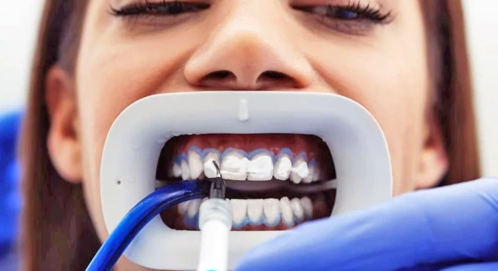 What Is Teeth Whitening, How Is It Done?