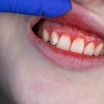 Zahnfleischentzündung: Symptome, Ursachen und die effektivsten Behandlungsmethoden