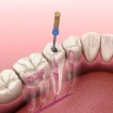 What is Endodontics? Everything You Need to Know About Root Canal Treatment