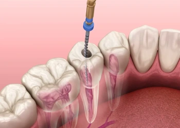 Was ist Endodontie? Alles über die endodontische Wurzelbehandlung