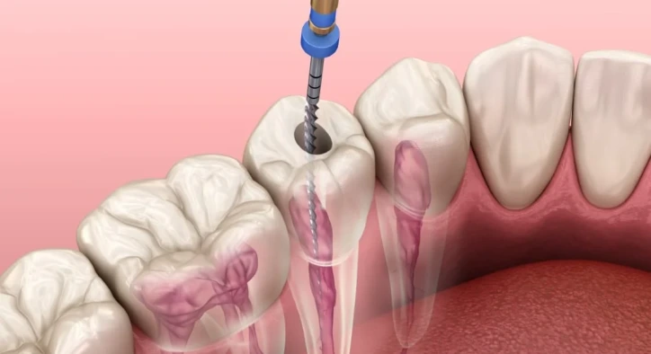 Endodonti Nedir? Endodontik Diş Tedavisi Hakkında Kapsamlı Rehber