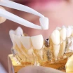 Wovon werden die Preise für Implantate bestimmt?