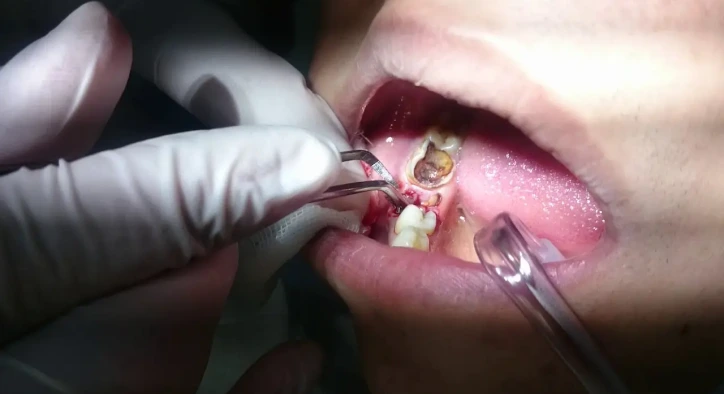 When Is Root Canal Treatment Tooth Extraction Necessary?
