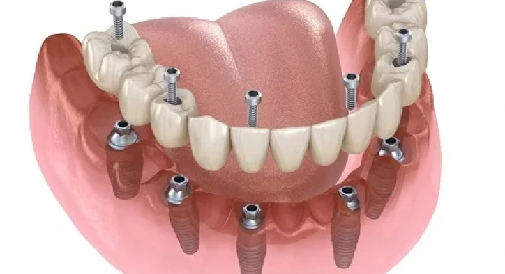 What Is All on 6 Implant? How Are They Done? 2026 Prices