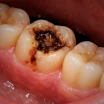 What is Good for Toothache Caused by Cavities? Temporary Home Remedies and Final Treatments