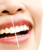 Things to Consider After Teeth Whitening