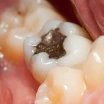 Why Are Dental Fillings Done? How Are They Done?