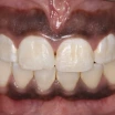 What Causes Gum Darkening? How to Treat Blackening and Bruising?
