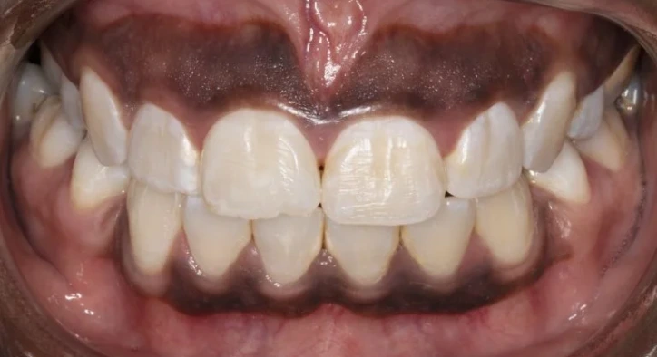 What Causes Gum Darkening? How to Treat Blackening and Bruising?