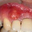 What Is Tooth Root Cyst? Symptoms, Root Canal & Surgery