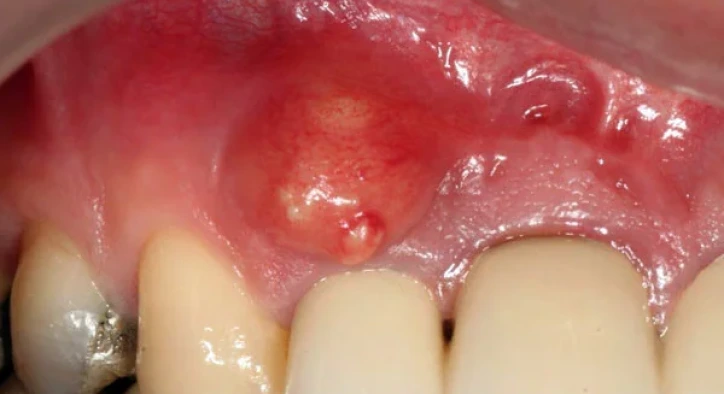 What Is Tooth Root Cyst? Symptoms, Root Canal & Surgery
