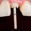 Was Ist Die Installation Von Glasfasermasten? Wie Erfolgt Sie und Wie Lange Ist Ihre Lebensdauer?