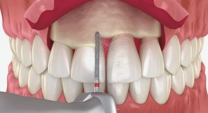 What Is Gingivectomy? How Is It Performed and Prices in 2026?