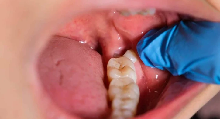 Frequently Asked Questions About Impacted Wisdom Tooth Extraction and Post-Surgery Care