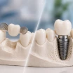 Dental Bridge or Implant? Which is Better & Long-Lasting?
