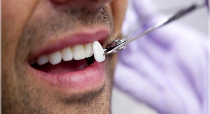 What Are Laminate Veneers? How Are They Done and What Are Their Prices In 2026?