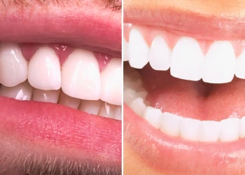 Zirconium or Laminate Veneers? Which is Better & Costly?