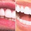 Zirkonium oder Laminat Veneers? Unterschiede & Kosten 2026