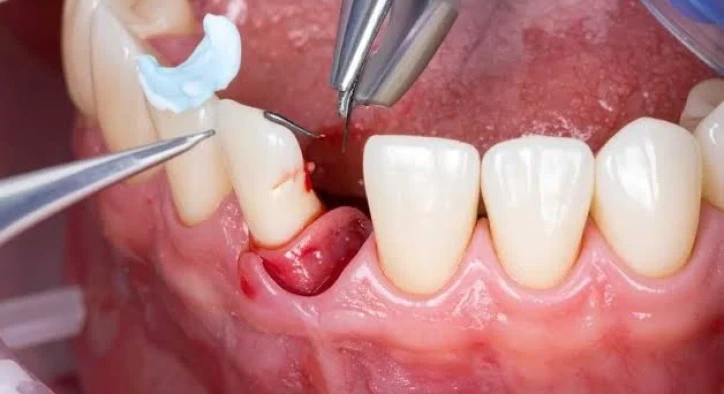 Apikal Rezeksiyon Nedir? Fiyatı ve Ameliyat Sonrası Bakım