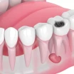 What Is a Jawbone Cyst? Symptoms, Surgery, and Treatment