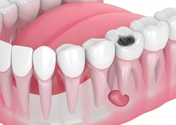 What Is a Jawbone Cyst? Symptoms, Surgery, and Treatment