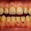 Was ist Zahnerosion? Symptome, Ursachen und Behandlung