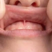 What Is a Frenectomy? Tongue-Tie and Lip-Tie Surgery and Aftercare