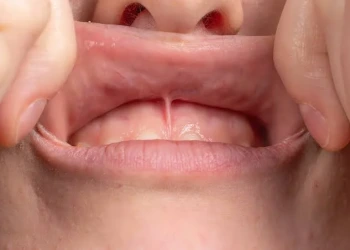 What Is a Frenectomy? Tongue-Tie and Lip-Tie Surgery and Aftercare