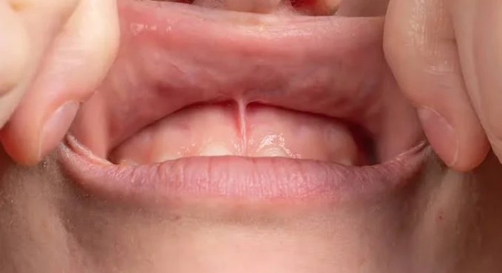 Frenektomi Nedir? Dil ve Dudak Bağı Ameliyatı ve Sonrası Bakım