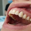 What Is a Temporary Tooth? How Is It Fitted, and What Happens If It Isn't?